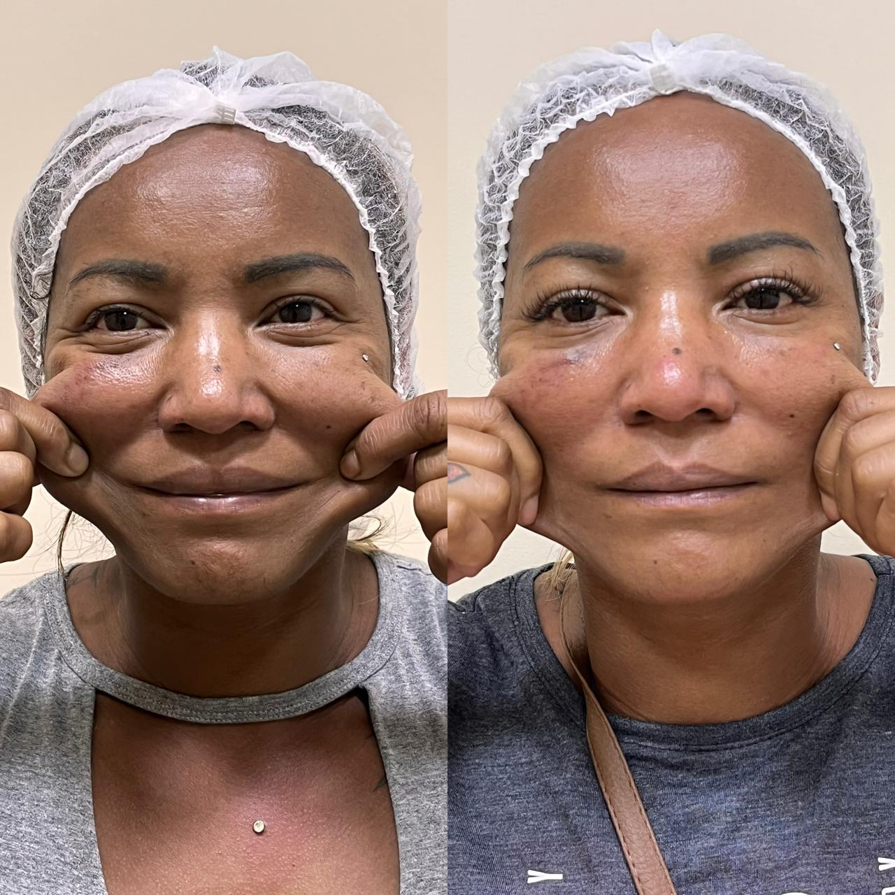 Antes e depois de Caso Clínico 02