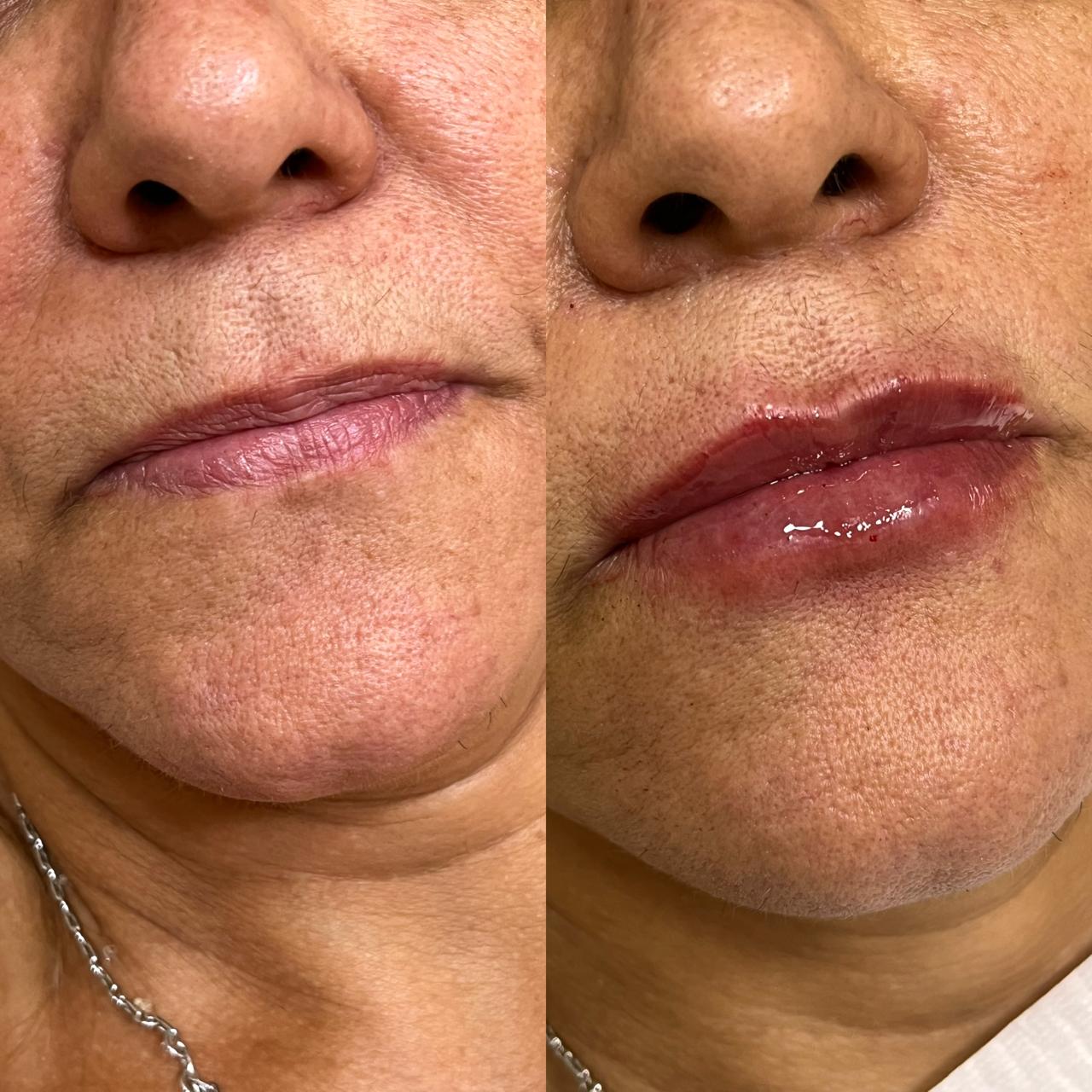 Preenchimento Labial — Lábio Fino