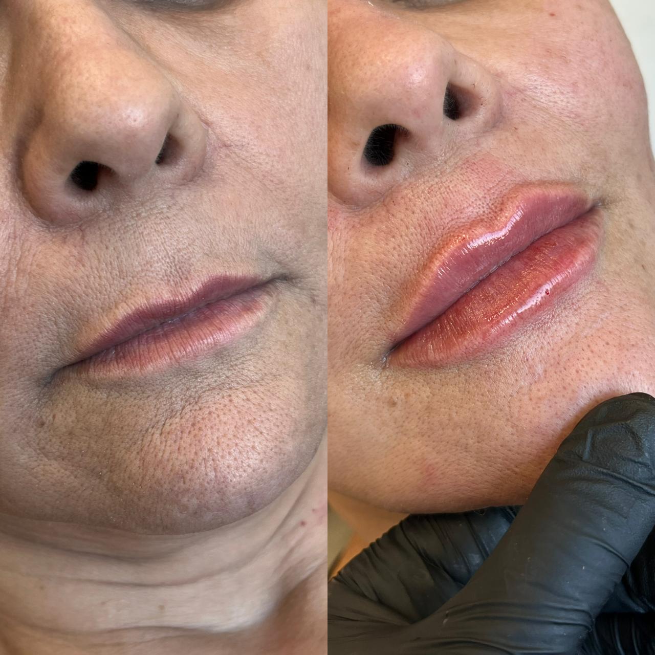 Antes e depois de Preenchimento Labial — Lábio Maduro