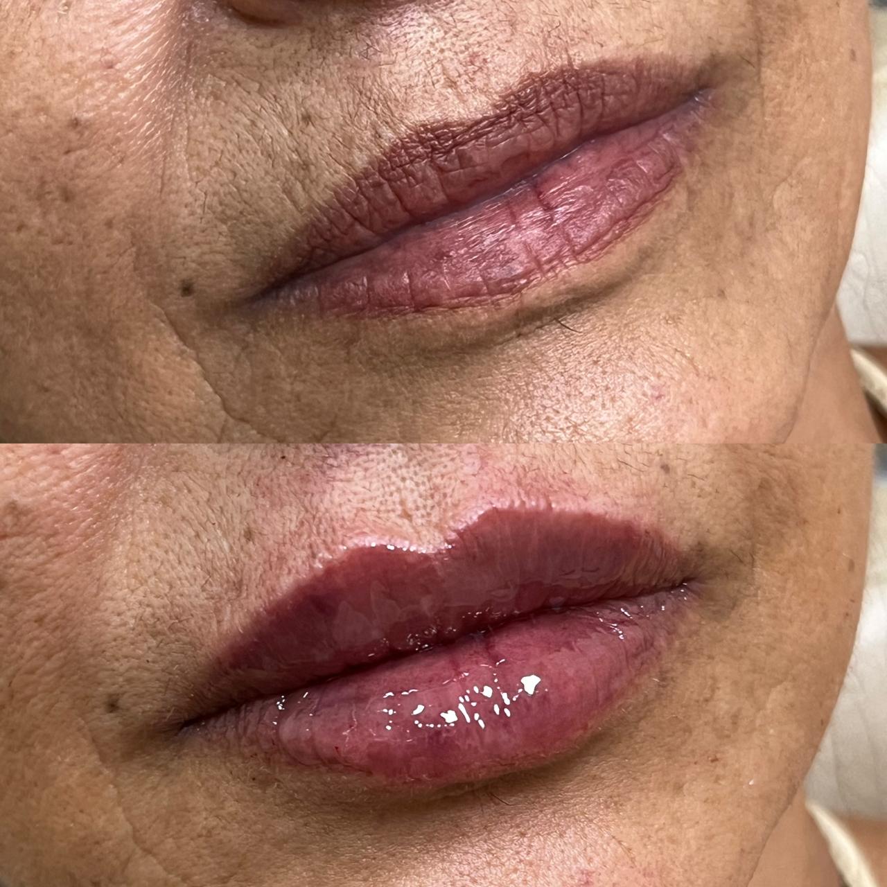 Antes e depois de Preenchimento Labial — Lábio Maduro