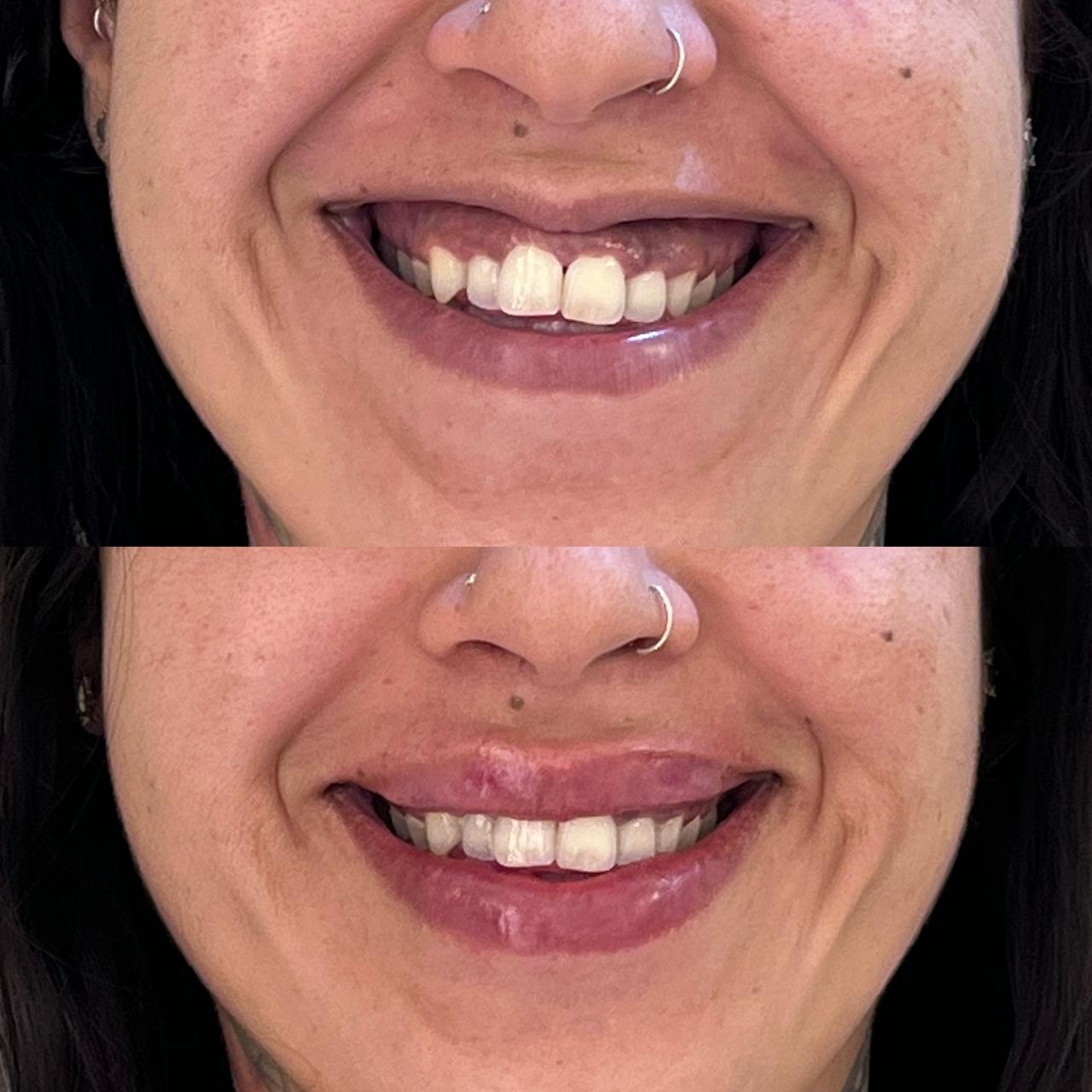 Antes e depois de Sorriso Gengival + Preenchimento Labial