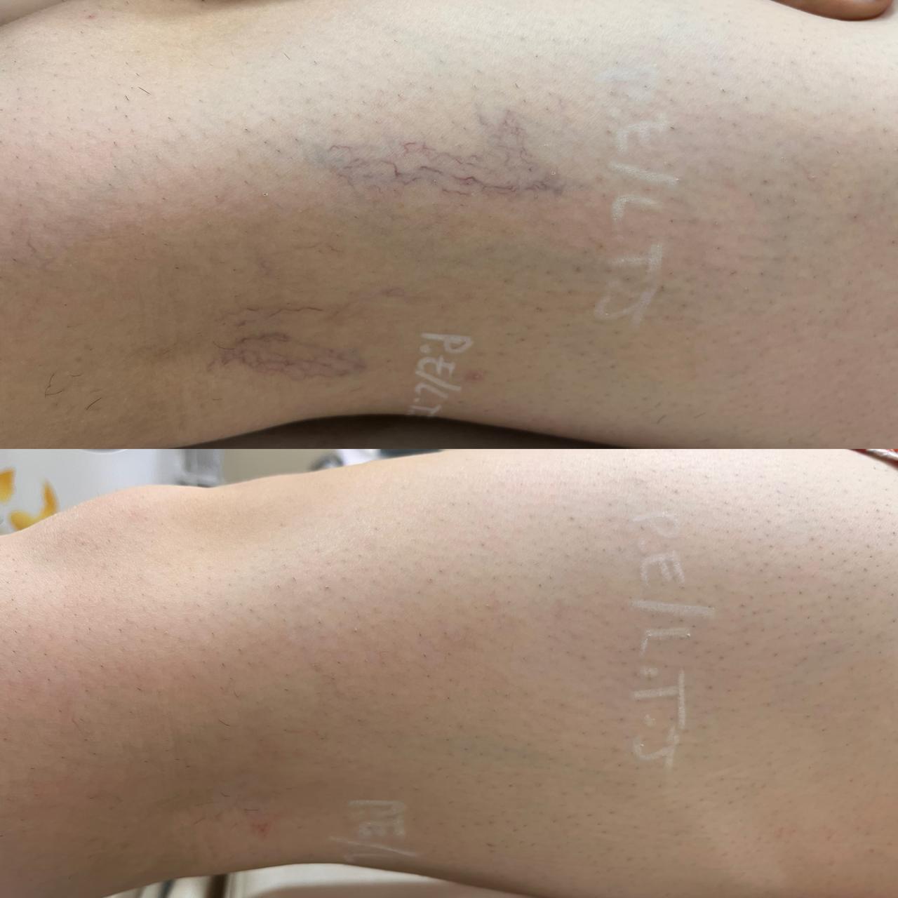 Antes e depois de Caso Clínico 03