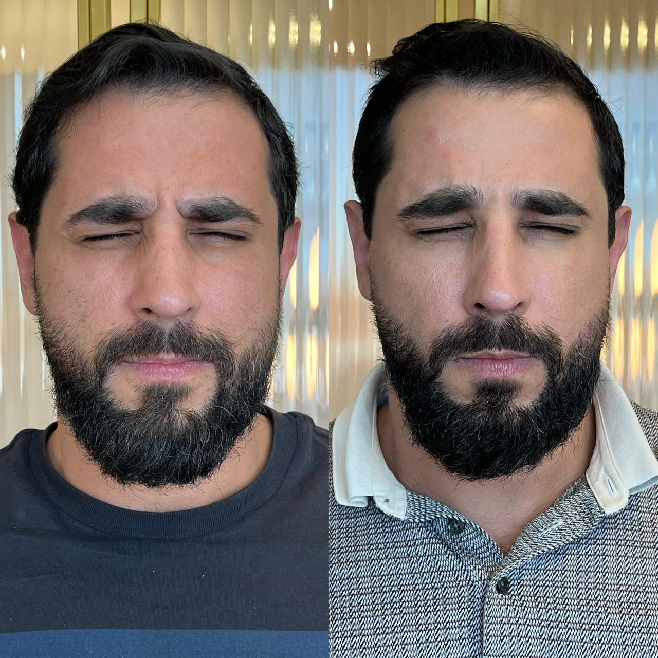 Antes e depois de Botox Masculino