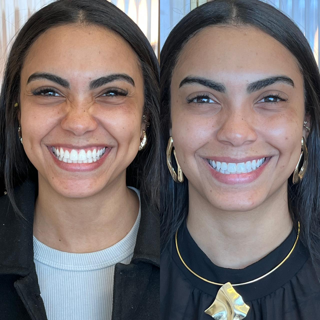 Antes e depois de Botox nos Pés de Galinha
